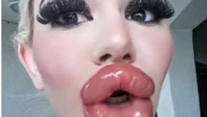 Bulgaristan'da genç kız Barbie'ye özenip 20'den fazla dudak dolgusu yaptırdı